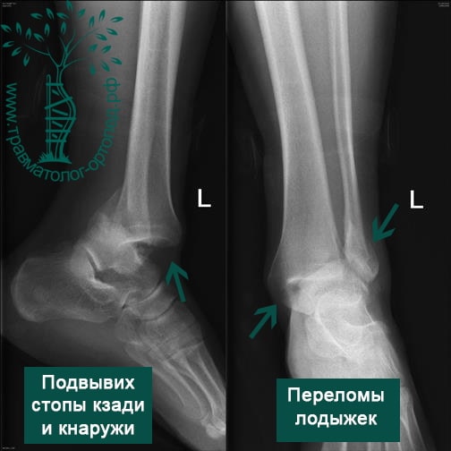 Реферат: Переломы лодыжек, повреждения голеностопного сустава